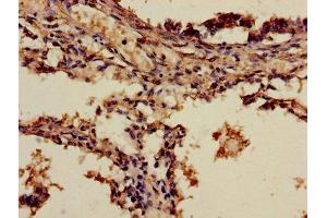 Immunohistochemistry of paraffin-embedded human lung cancer using ABIN7143652 at dilution of 1:100 (ADH7 抗体  (AA 1-386))
