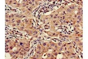 Immunohistochemistry of paraffin-embedded human lung cancer using ABIN7175463 at dilution of 1:100 (VTI1A 抗体  (AA 1-175))