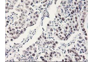 Immunohistochemical staining of paraffin-embedded Carcinoma of Human lung tissue using anti-RBBP7 mouse monoclonal antibody. (RBBP7 抗体)