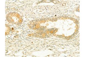 ABIN6265394 and ABIN6266638 at 1/100 staining Human normal tissues adjacent to pancreatic cancer by IHC-P. (Synaptophysin 抗体  (Internal Region))