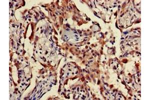 Immunohistochemistry of paraffin-embedded human lung cancer using ABIN7166452 at dilution of 1:100 (TPST1 抗体  (AA 283-370))
