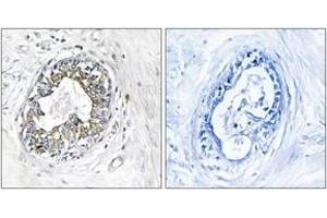 Immunohistochemistry analysis of paraffin-embedded human breast carcinoma tissue, using PAK1/2 (Ab-199) Antibody. (PAK1/2 抗体  (AA 165-214))