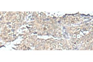 Immunohistochemistry of paraffin-embedded Human ovarian cancer tissue using MEF2D Polyclonal Antibody at dilution of 1:50(x200) (MEF2D 抗体)