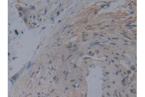 Detection of NOG in Human Pancreatic cancer Tissue using Monoclonal Antibody to Noggin (NOG) (NOG 抗体  (AA 28-232))