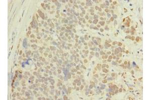 Immunohistochemistry of paraffin-embedded human gastric cancer using ABIN7143116 at dilution of 1:100 (ACTRT1 抗体  (AA 201-376))