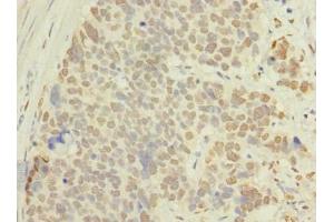 Immunohistochemistry of paraffin-embedded human gastric cancer using ABIN7143116 at dilution of 1:100 (ACTRT1 抗体  (AA 201-376))