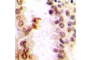 Immunohistochemical analysis of c-Jun staining in human lung cancer formalin fixed paraffin embedded tissue section.