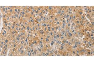 Immunohistochemistry of paraffin-embedded Human liver cancer using NFE2L1 Polyclonal Antibody at dilution of 1:30 (NFE2L1 抗体)
