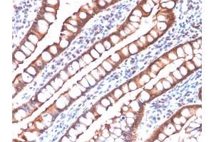 Formalin-fixed, paraffin-embedded human Small Intestinal Carcinoma stained with Villin-Monospecific Recombinant Mouse Monoclonal Antibody (rVIL1/1325). (Recombinant Villin 1 抗体  (AA 179-311))