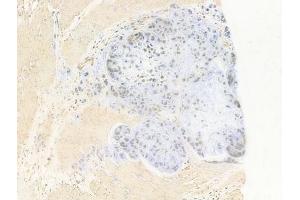 ABIN6264373 and ABIN6277684 at 1/100 staining human gastric carcinoma by IHC-P. (PPARD 抗体  (C-Term))