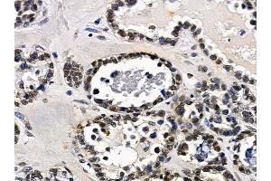 ABIN7097182 and ABIN7101250 at 1/100 staining human ovarian cancer by IHC-P. (FAM122B 抗体)
