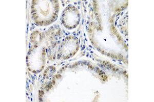 Immunohistochemistry of paraffin-embedded human colon carcinoma using SSX2 antibody at dilution of 1:200 (40x lens). (SSX2 抗体)