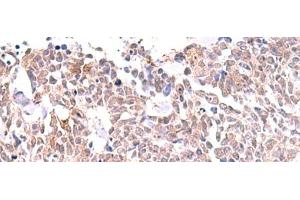 Immunohistochemistry of paraffin-embedded Human lung cancer tissue using INPP5K Polyclonal Antibody at dilution of 1:85(x200) (INPP5K 抗体)