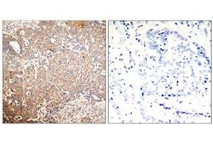 Immunohistochemical analysis of paraffin-embedded human breast carcinoma tissue using Keratin 18 (Phospho-Ser33) antibody (E011306). (Cytokeratin 18 抗体  (pSer33))
