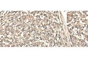 Immunohistochemistry of paraffin-embedded Human esophagus cancer tissue using BUD31 Polyclonal Antibody at dilution of 1:75(x200)