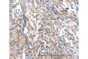 Immunohistochemistry of Human esophagus cancer using APOBEC3D Polyclonal Antibody at dilution of 1:80 (APOBEC3D 抗体)