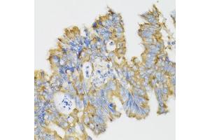 Immunohistochemistry of paraffin-embedded human rectal cancer using GHRL antibody (ABIN6131231, ABIN6141079, ABIN6141080 and ABIN6216264) at dilution of 1:100 (40x lens). (Ghrelin 抗体  (AA 1-117))