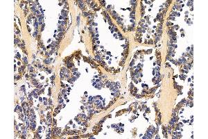 ABIN7095873 and ABIN7099935 at 1/100 staining human ovarian cancer by IHC-P. (C1orf151 抗体)
