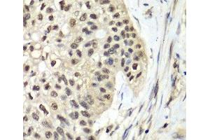 Immunohistochemistry of paraffin-embedded Human lung cancer using RFC5 Polyclonal Antibody at dilution of 1:100 (40x lens). (RFC5 抗体)