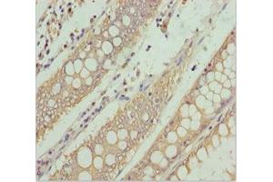 Immunohistochemistry of paraffin-embedded human colon cancer using ABIN7169114 at dilution of 1:100 (NEK8 抗体  (AA 1-300))