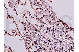 Formalin-fixed and paraffin embedded human lung labeled with Anti-Beta-HCG/HCG beta Polyclonal Antibody, Unconjugated (ABIN730243) at 1:200, followed by conjugation to the secondary antibody and DAB staining (HCG beta 抗体  (AA 81-165))