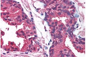 Human Prostate (formalin-fixed, paraffin-embedded) stained with AKT1 antibody ABIN214085 at 5 ug/ml followed by biotinylated goat anti-rabbit IgG secondary antibody ABIN481713, alkaline phosphatase-streptavidin and chromogen.