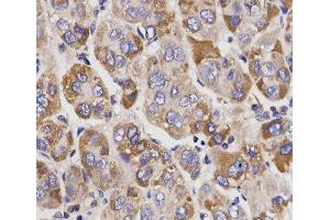 Immunohistochemistry of paraffin-embedded Human liver cancer using UGT1A9 Polyclonal Antibody at dilution of 1:200 (40x lens). (UGT1A9 抗体)