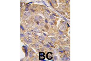 Formalin-fixed and paraffin-embedded human breast carcinoma tissue reacted with EIF4B polyclonal antibody  , which was peroxidase-conjugated to the secondary antibody, followed by DAB staining. (EIF4B 抗体  (Ser422))