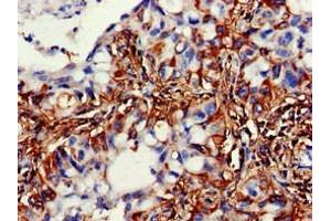 Immunohistochemistry of paraffin-embedded human lung cancer using ABIN7169541 at dilution of 1:100 (ACADSB 抗体  (AA 34-253))