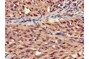 Immunohistochemistry of paraffin-embedded human lung cancer using ABIN7170803 at dilution of 1:100 (STOML3 抗体  (AA 205-291))