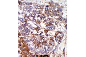 Formalin-fixed and paraffin-embedded human cancer tissue reacted with the primary antibody, which was peroxidase-conjugated to the secondary antibody, followed by AEC staining. (PRKG1 抗体  (C-Term))