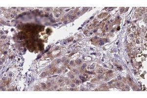 ABIN6277418 at 1/100 staining Human liver cancer tissue by IHC-P. (P2RY4 抗体  (C-Term))