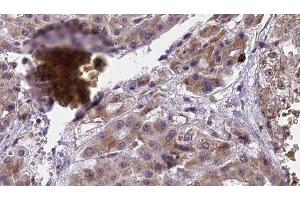 ABIN6277418 at 1/100 staining Human liver cancer tissue by IHC-P.