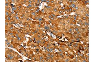 The image on the left is immunohistochemistry of paraffin-embedded Human liver cancer tissue using ABIN7130896(RNF14 Antibody) at dilution 1/20, on the right is treated with fusion protein. (RNF14 抗体)