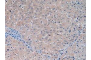 Detection of DBP in Human Liver Cancer Tissue using Polyclonal Antibody to Vitamin D Binding Protein (DBP) (Vitamin D-Binding Protein 抗体  (AA 209-401))