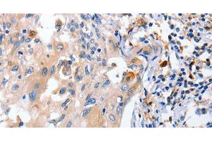 Immunohistochemistry of paraffin-embedded Human cervical cancer using IL18 Polyclonal Antibody at dilution of 1:100 (IL-18 抗体)
