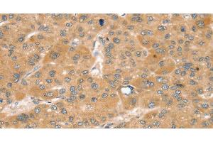 Immunohistochemistry of paraffin-embedded Human liver cancer using SNX2 Polyclonal Antibody at dilution of 1:40 (Sorting Nexin 2 抗体)