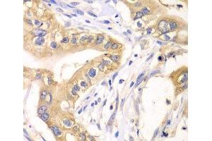 Immunohistochemistry of paraffin-embedded Human liver cancer using HAGH Polyclonal Antibody at dilution of 1:100 (40x lens). (HAGH 抗体)
