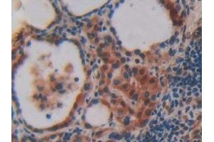 Detection of VAV3 in Human Thyroid Tissue using Polyclonal Antibody to Vav 3 Oncogene (VAV3) (VAV3 抗体  (AA 183-380))
