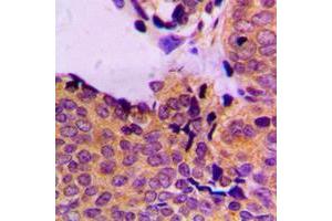 Immunohistochemical analysis of PDPK1 (pS241) staining in human breast cancer formalin fixed paraffin embedded tissue section. (PDPK1 抗体  (pSer241))