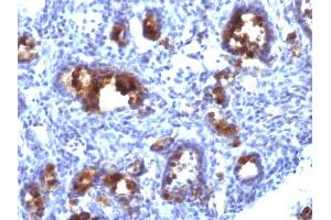Formalin-fixed, paraffin-embedded human Gastric Carcinoma stained with MUC3 Monoclonal Antibody (MUC3/1154). (MUC3A 抗体)
