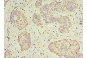 Immunohistochemistry of paraffin-embedded human gastric cancer using ABIN7142267 at dilution of 1:100 (MRPS31 抗体  (AA 66-395))
