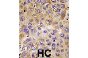 Formalin-fixed and paraffin-embedded human hepatocellular carcinoma reacted with PFKFB1 polyclonal antibody  , which was peroxidase-conjugated to the secondary antibody, followed by DAB staining. (PFKFB1 抗体  (Internal Region))