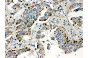 Anti- BMP5 Picoband antibody, IHC(P) IHC(P): Human Lung Cancer Tissue (BMP5 抗体  (C-Term))