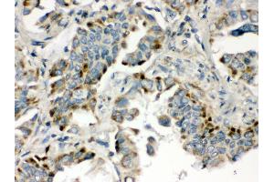 Anti- BMP5 Picoband antibody, IHC(P) IHC(P): Human Lung Cancer Tissue
