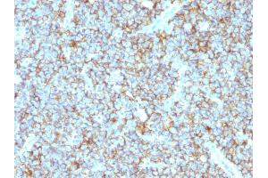 Formalin-fixed, paraffin-embedded human Ewing's Sarcoma stained with CD99 Rabbit Recombinant Monoclonal Antibody (MIC2/1495R). (Recombinant CD99 抗体)