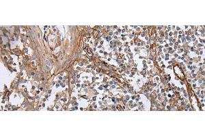 Immunohistochemistry of paraffin-embedded Human tonsil tissue using BLVRB Polyclonal Antibody at dilution of 1:65(x200) (BLVRB 抗体)