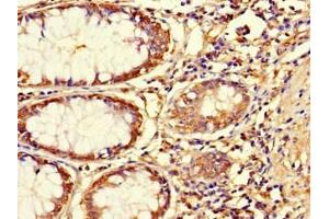 Immunohistochemistry of paraffin-embedded human colon cancer using ABIN7144761 at dilution of 1:100 (Asporin 抗体  (AA 33-380))