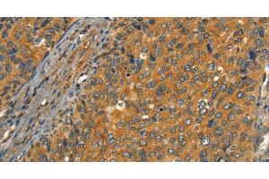 Immunohistochemistry of paraffin-embedded Human cervical cancer tissue using CIB1 Polyclonal Antibody at dilution 1:30 (CIB1 抗体)