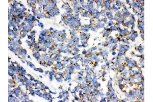 Anti- mtTFA Picoband antibody,IHC(P) IHC(P): Human Lung Cancer Tissue (TFAM 抗体  (N-Term))
